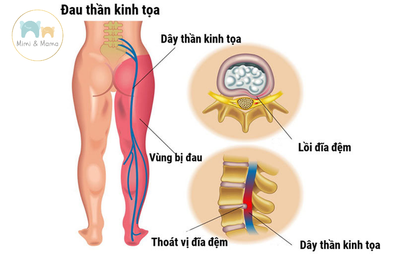 Đau thần kinh tọa do thai nhi chèn ép