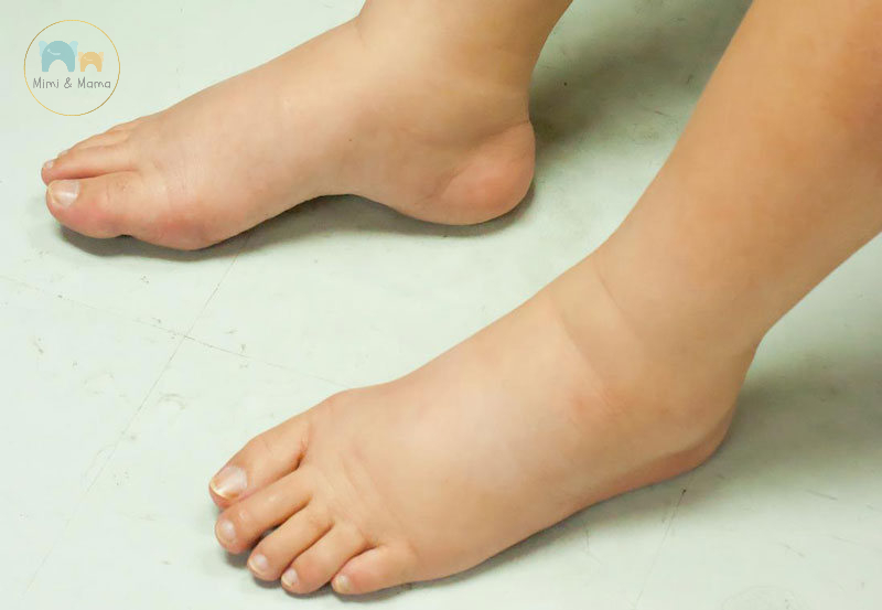 Mẹ bầu bị phù chân nguy hiểm (cảnh báo tiền sản giật)
