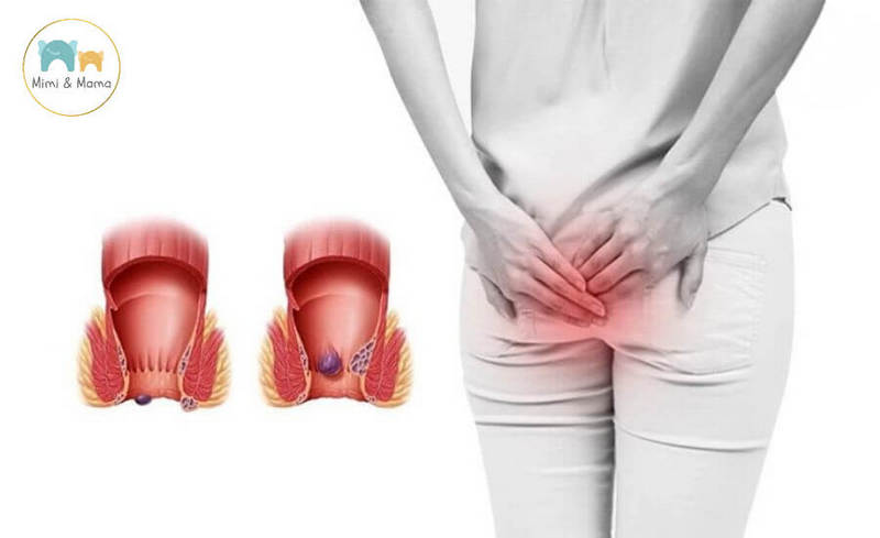 Mẹ sau sinh bị táo bón nặng phải làm sao? Giải pháp dùng thuốc