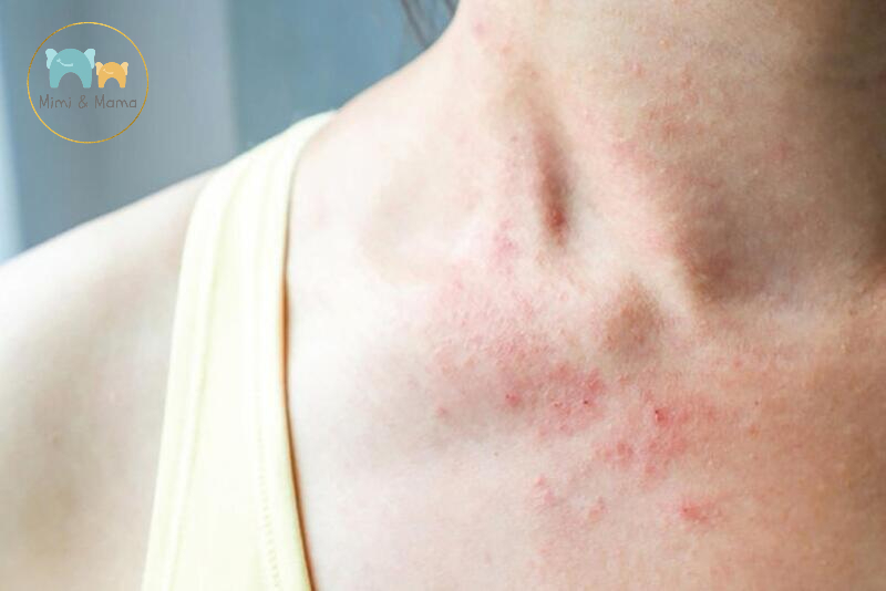 Vậy mẹ bầu bị dị ứng có nguy hiểm không?