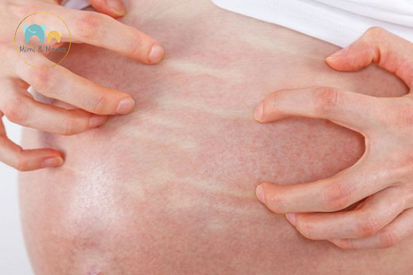 Phương pháp điều trị và xử lý dị ứng an toàn cho bà bầu