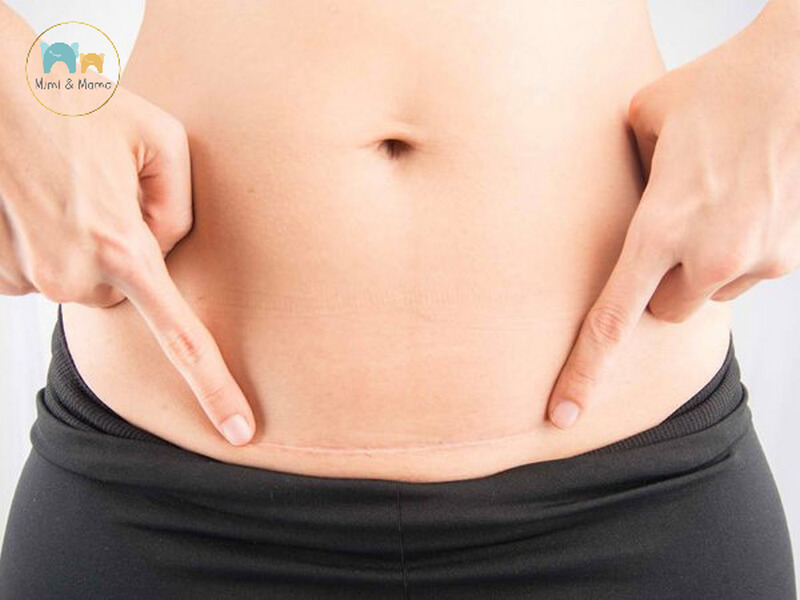 Hình thành mô sẹo và dính gây ra ngấn mỡ trên vết mổ